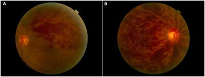 Altered synchronous neural activities in retinal vein occlusion patients: A resting-state fMRI study